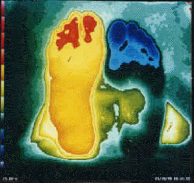 db_RSD__Neuroma_Exploration_Thermo_copy1