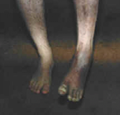 db_Left_Foot_Deformity_Pic_-4_copy1